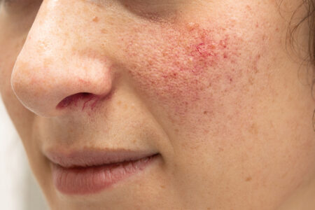 Rosacea-Treatment-Bournemouth